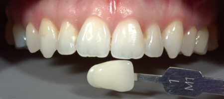 LA IMPORTANCIA DE LA FOTOGRAFÍA DENTAL